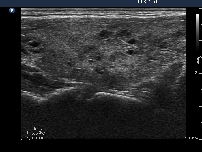 Right lobe, longitudinal scan