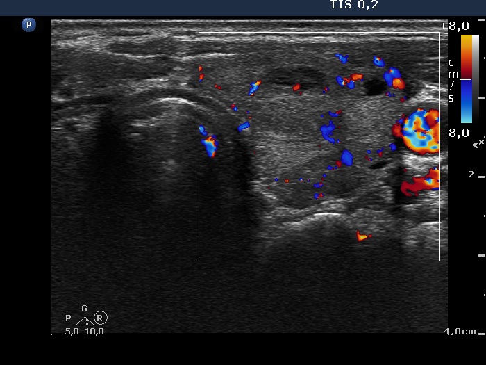 Right lobe, longitudinal scan