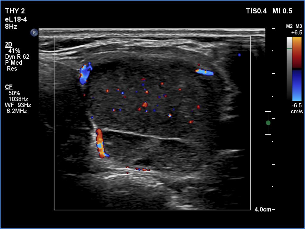 Right lobe, longitudinal scan