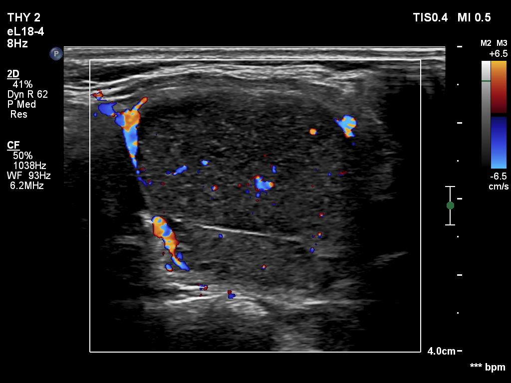 Right lobe, longitudinal scan