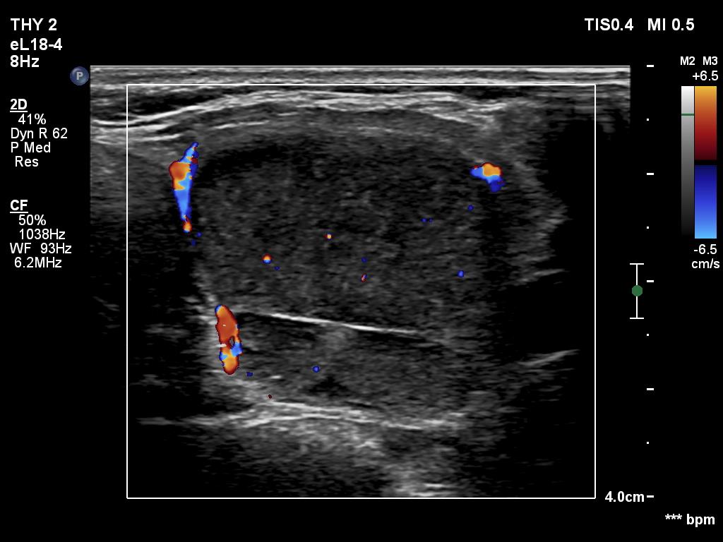 Right lobe, longitudinal scan