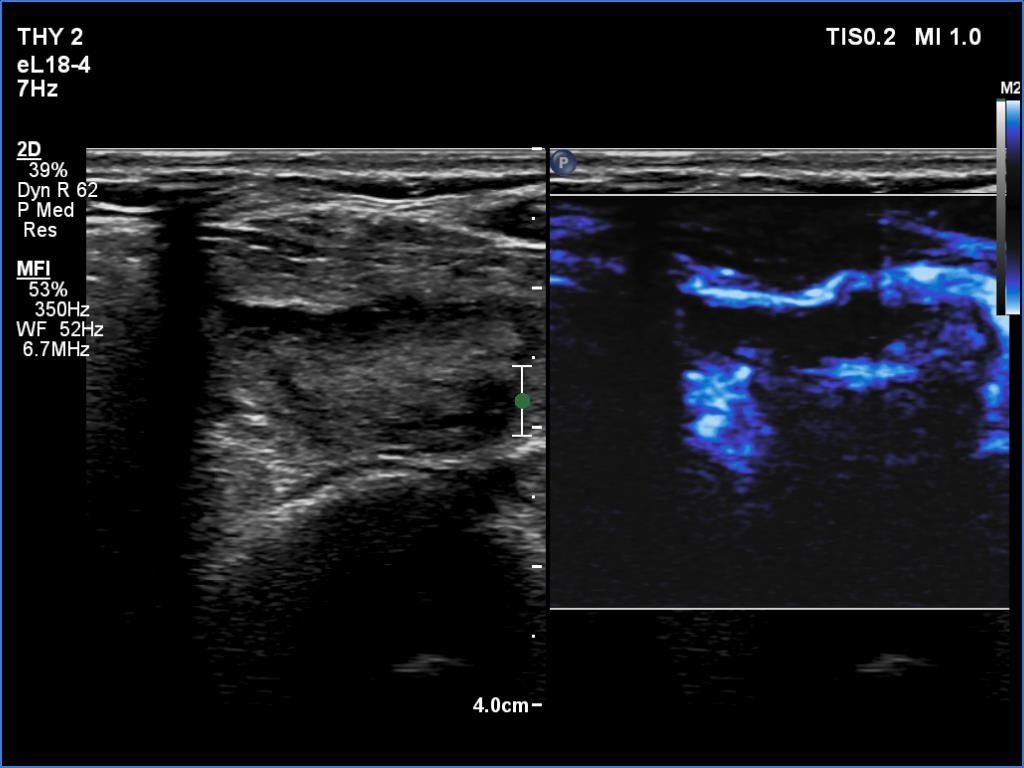 Right lobe, longitudinal scan