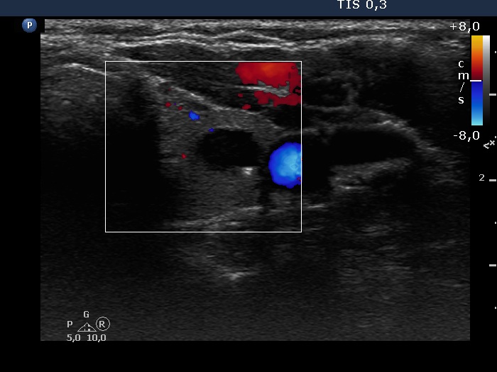 Right lobe, longitudinal scan
