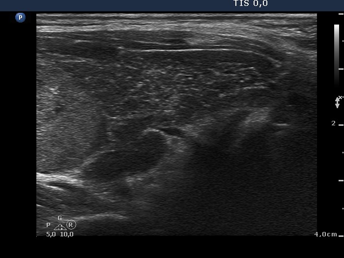 Right lobe, longitudinal scan