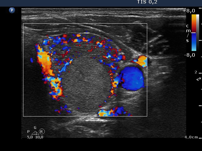 Right lobe, longitudinal scan