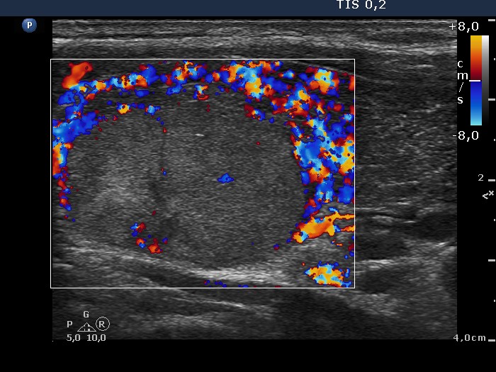 Right lobe, longitudinal scan