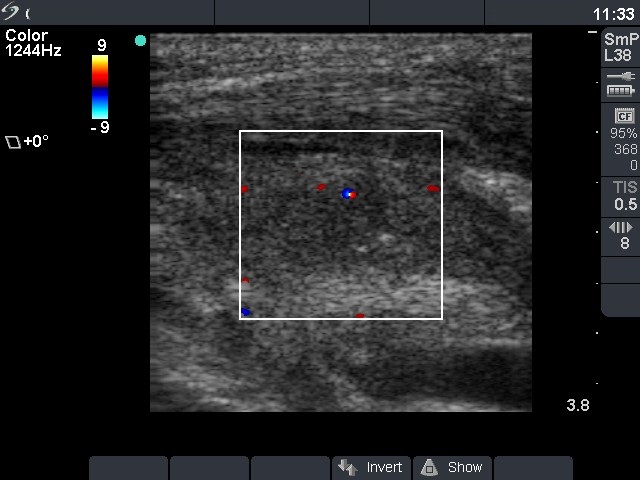 Right lobe, longitudinal scan
