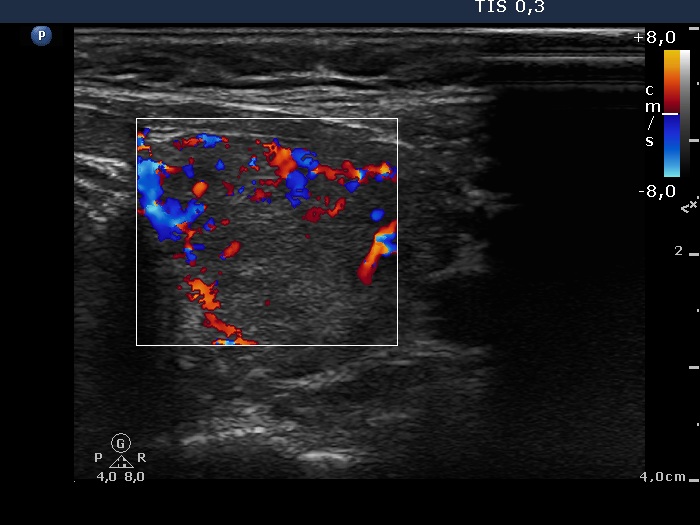 Right lobe, longitudinal scan