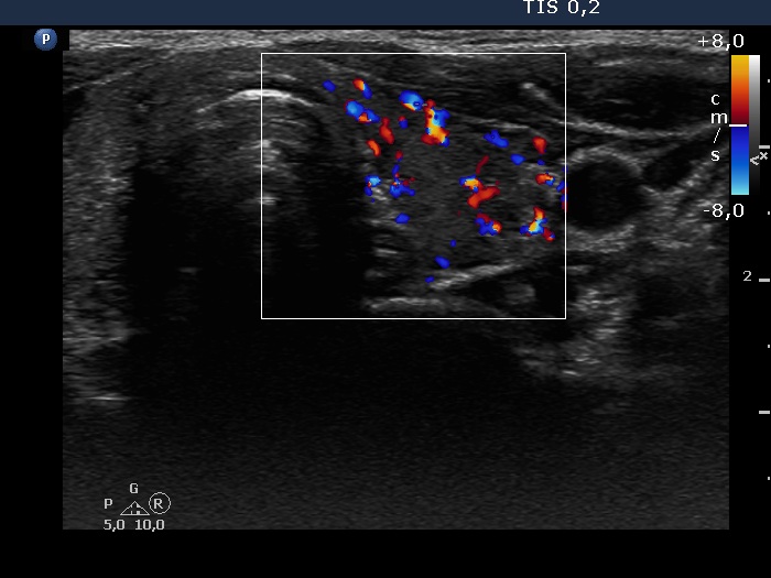 Right lobe, longitudinal scan
