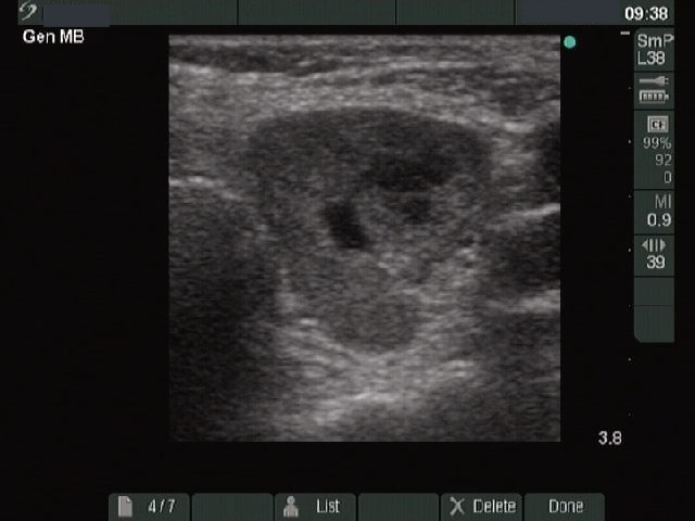 Right lobe, longitudinal scan