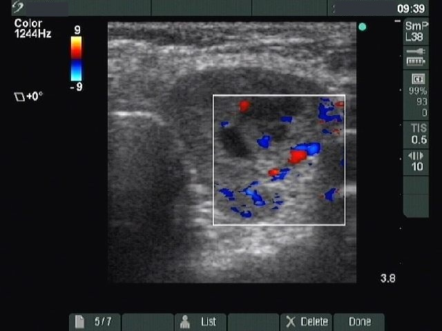 Right lobe, longitudinal scan