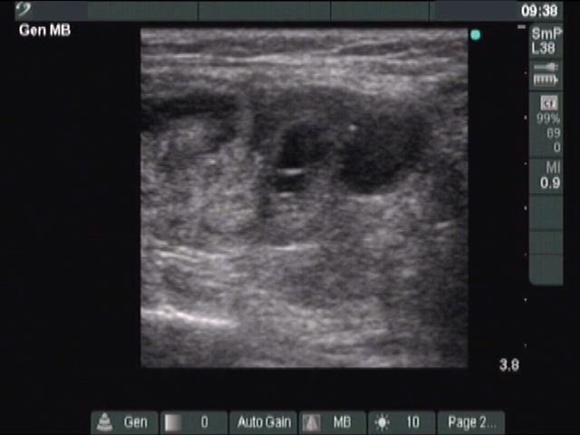 Right lobe, longitudinal scan