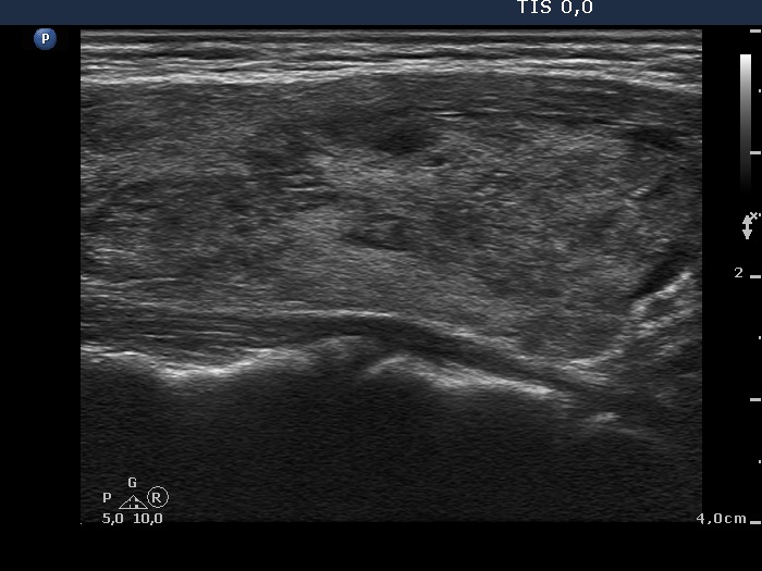 Right lobe, longitudinal scan