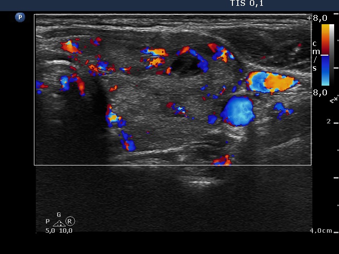 Right lobe, longitudinal scan