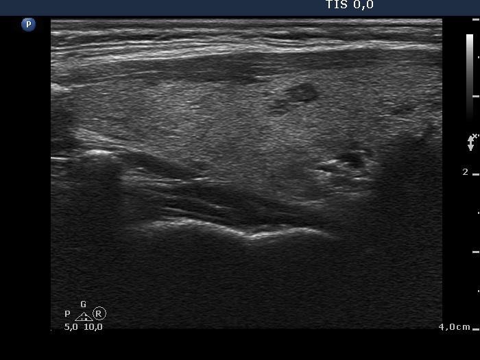 Right lobe, longitudinal scan