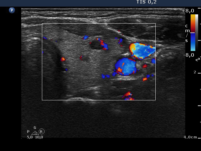 Right lobe, longitudinal scan