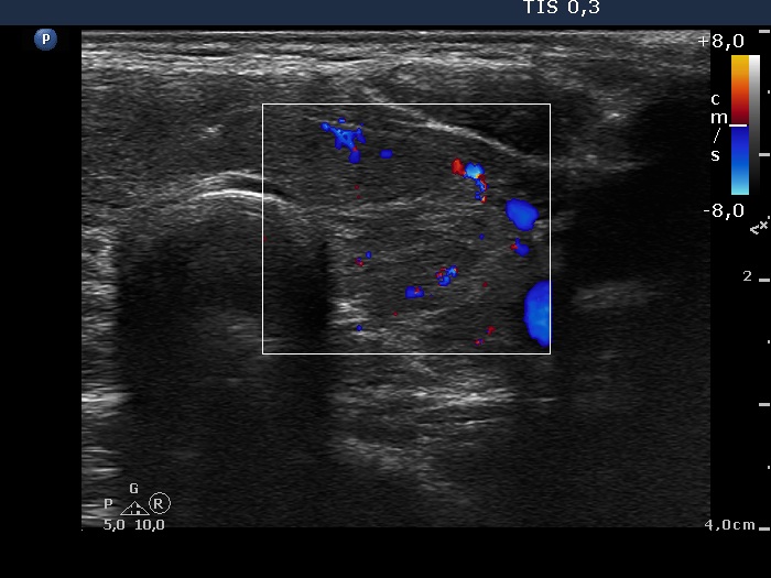 Right lobe, longitudinal scan