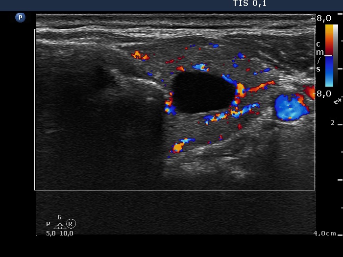 Right lobe, longitudinal scan