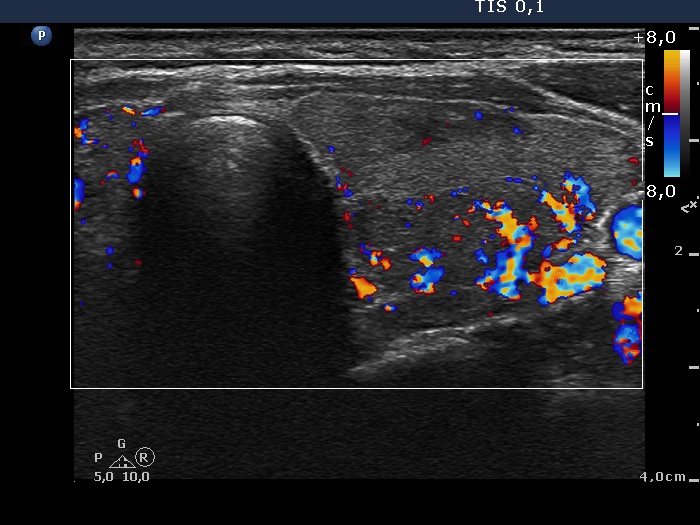 Right lobe, longitudinal scan