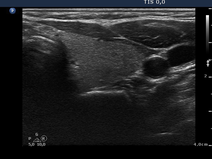 Right lobe, longitudinal scan