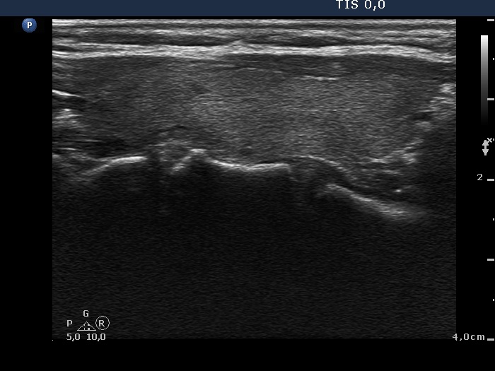 Right lobe, longitudinal scan