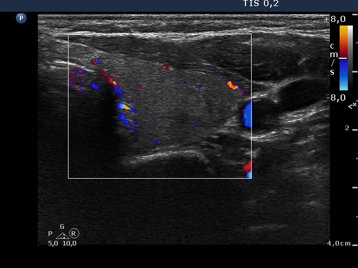 Right lobe, longitudinal scan
