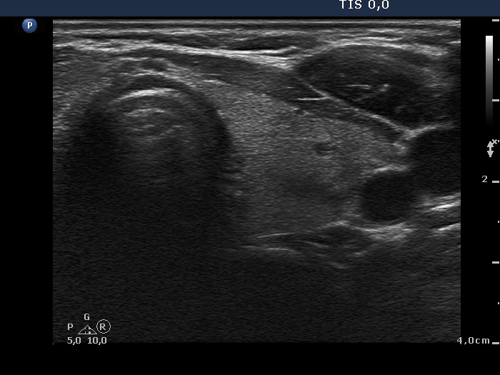 Right lobe, longitudinal scan