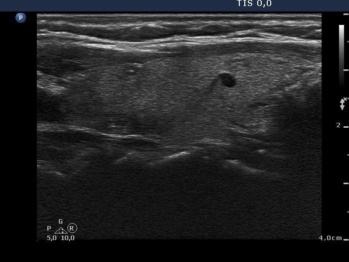 Right lobe, longitudinal scan