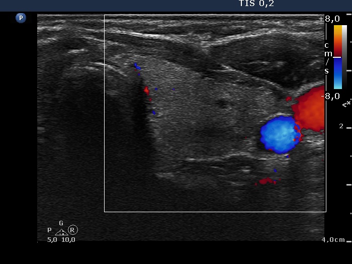 Right lobe, longitudinal scan