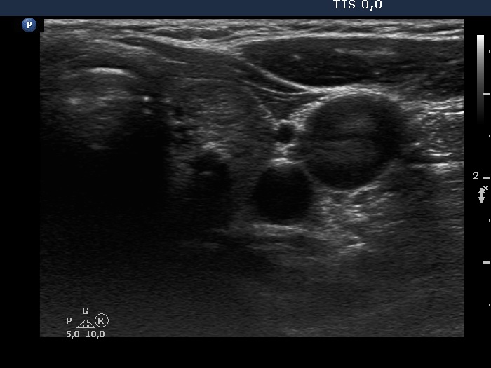 Right lobe, longitudinal scan