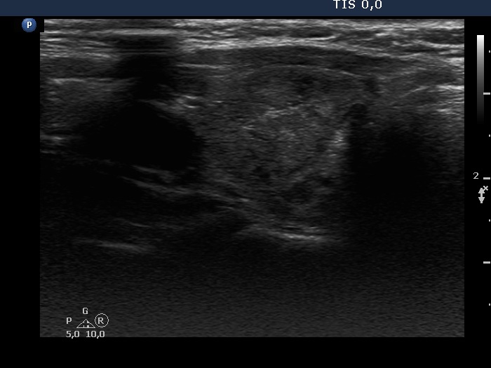 Right lobe, longitudinal scan