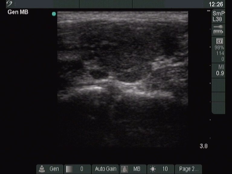 Right lobe, longitudinal scan