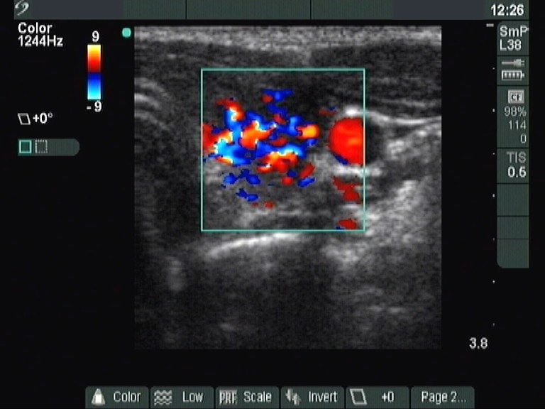 Right lobe, longitudinal scan