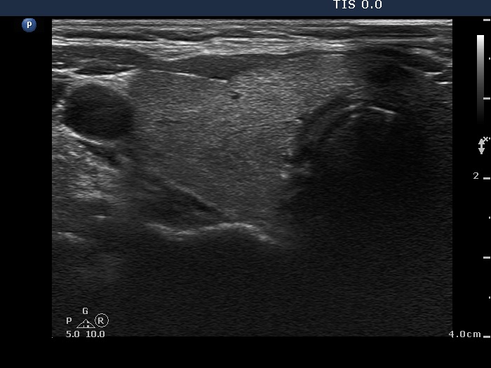 Right lobe, horizontal view