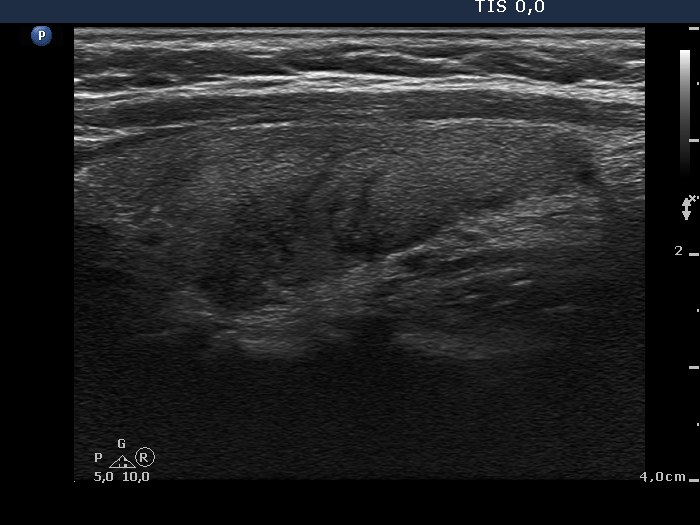 Right lobe, longitudinal scan