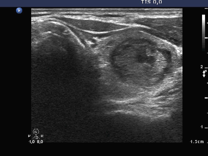 Right lobe, horizontal view