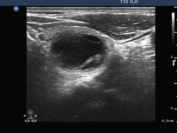 Right lobe, horizontal view