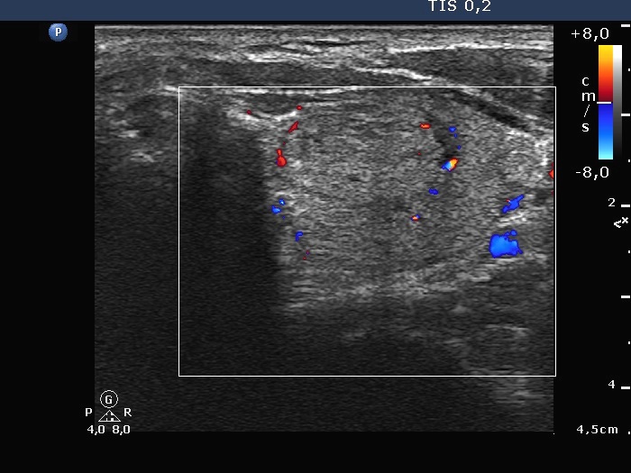 Right lobe, horizontal view