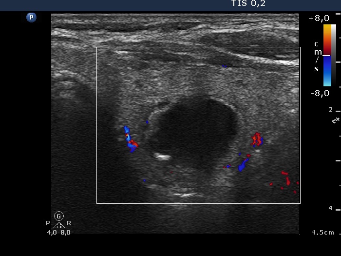 Right lobe, longitudinal scan
