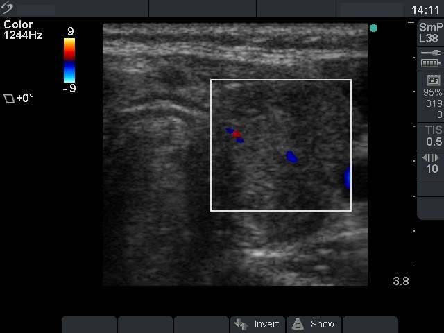 Right lobe, longitudinal scan