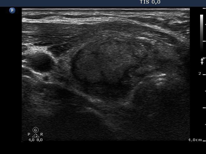 Right lobe, longitudinal scan