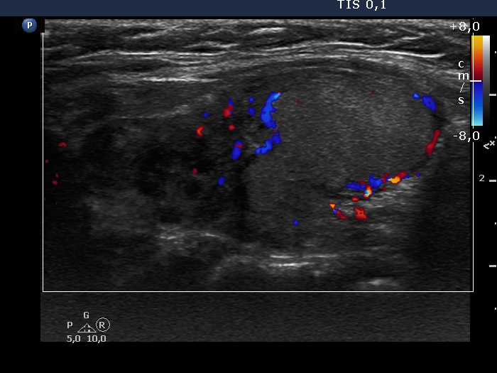 Right lobe, longitudinal scan