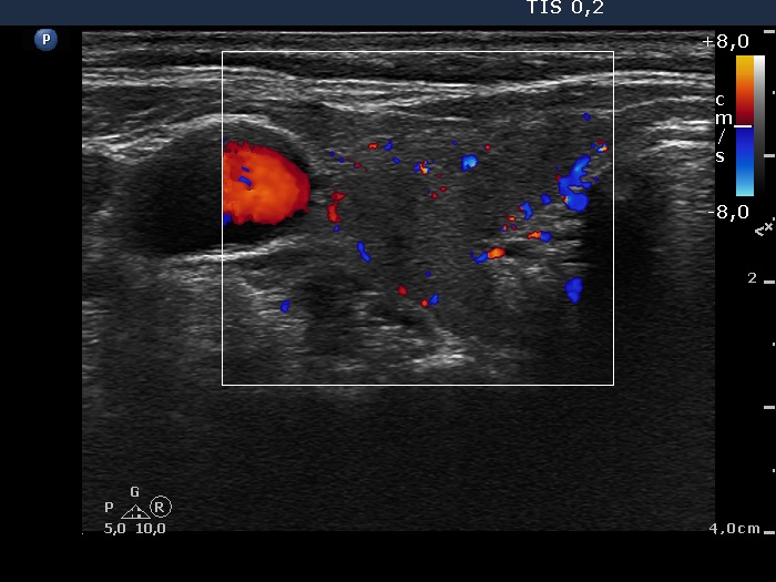 Right lobe, longitudinal scan