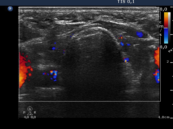 Right lobe, longitudinal scan