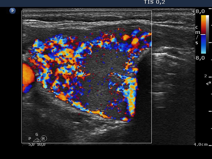 Right lobe, longitudinal scan