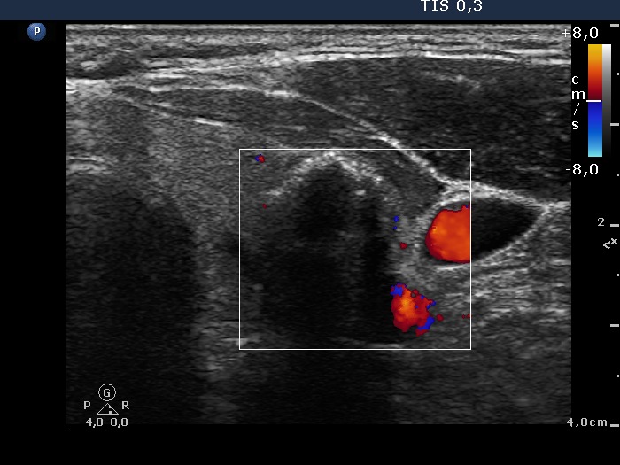 Right lobe, longitudinal scan