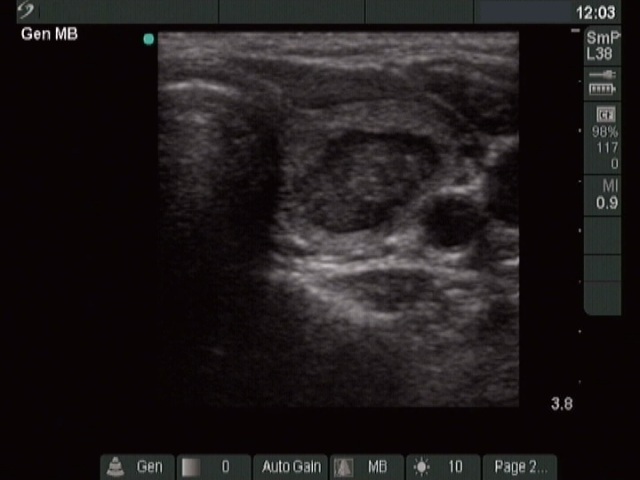 Right lobe, longitudinal scan