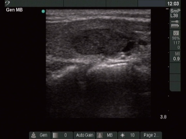 Right lobe, longitudinal scan