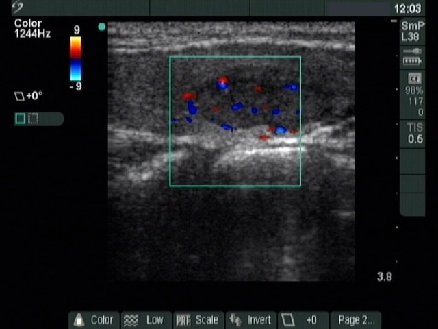 Right lobe, longitudinal scan