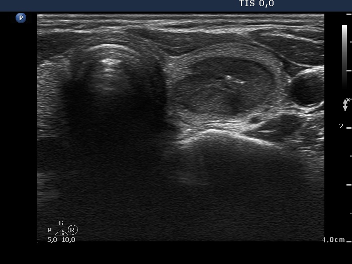 Right lobe, longitudinal scan